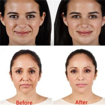 China Injeção facial ácida hialurónica do Hyaluronidase de Juvederm Voluma do enchimento à venda