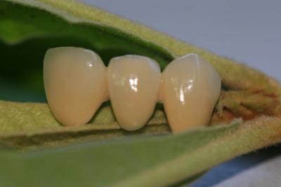 Κίνα ISO13485 καλή πολύτιμη οδοντική κορώνα Biocompatibility PFM μη προς πώληση