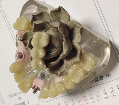 中国 100% Biocompatibility PMMAの仮の王冠 販売のため