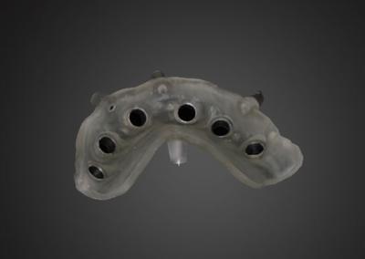 China Surgical sguide Plan for Implant Supported Crown Design and Alveolar Bone Information for sale