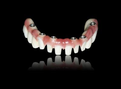 China ALL On X Implant Zirconia Bridge Implant Crown Bridge Natural Appearance for sale