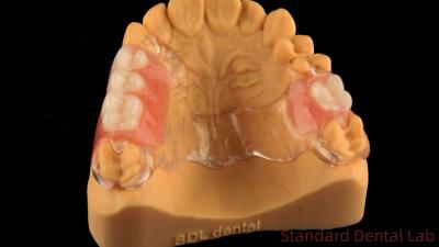 China Flexibel helder gegoten metaal frame gedeeltelijke gebit hoge esthetiek perfecte pasvorm Te koop