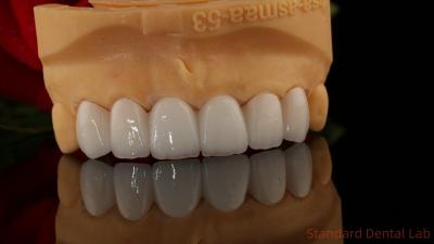 China Full Contour Zirconia Crown Translucency 3D PRO No Porcelian Overlay Standard Dental Lab for sale