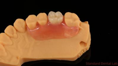 China Tandheelkundige TCS Valplast Flexible Partial Protheses Nesbit Valplast Finish China Dental Lab Valplast Clamp Te koop