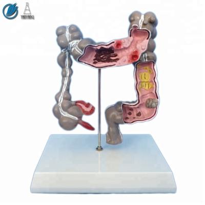 China Medical human common pathologies of colon and rectum model for sale