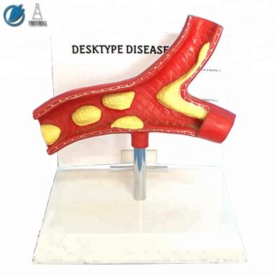 China Medical Pathological Vascular Model Hypertension Harmful Effects for sale