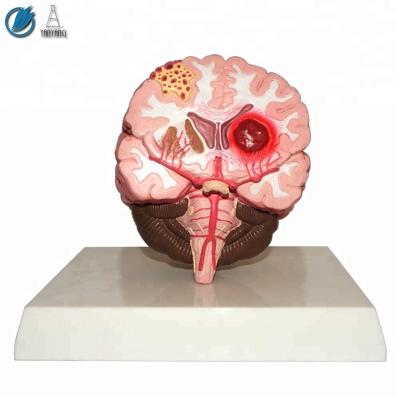 China Medical Subject Brain Stroke Demonstration Teaching Medical Science Model for sale