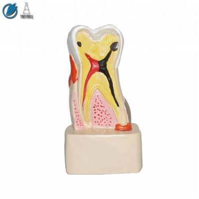 China 4 Periods Caries Medical Human Pathology Dental Model for sale