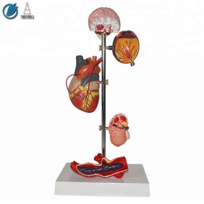 China Medical science medical subject hypertension set human model for sale