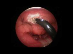 Fast Healing Plasma Wand Tonsillectomy , Adnoidectomy RF Ablation System