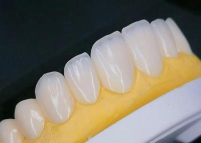 China EMAX Porcelain Veneer with Stain Resistance for Natural looking Esthetic Restorations for sale