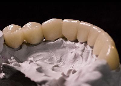 China Comfortable  Dental Crown Porcelain Fused To Metal ,  PFM Metal Crown Stain Resistant for sale