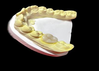 China Smooth Ceramic Inlays Onlays Strong and Hypoallergenic Dental Restoration for Damaged Teeth for sale