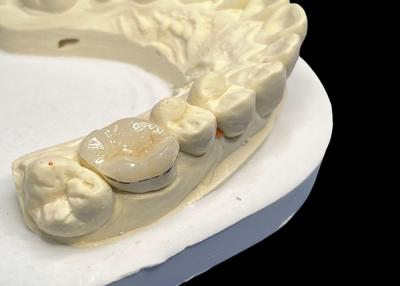 China Hypoallergenic Teeth Repair Porcelain Inlays Onlays Natural Color Easy Maintenance for sale