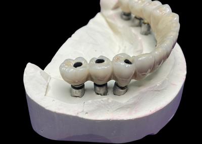 China The Dental Implant With A Titanium Base Is Topped With A Beautiful Ceramic Crown Bridge To Create A Perfect Restoration. for sale