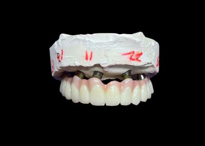 China Dental Implant Supported Fixed Full Arch Dentures for a Permanent, Stable, and Natural-Looking Solution to Missing Teeth for sale