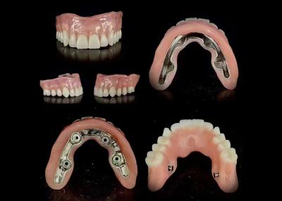 China Precise Bar Implant Supported Hybrid Denture Secure Fit Adjustable Stability for sale