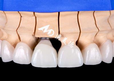 China Functional Aesthetic Dental Implant Crown Bridge – Precision and Durability for sale