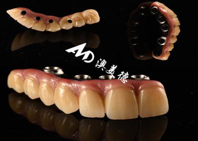 China Natural Looking Dental Implant Crown bridge Fixed with Titanium abutment for Missing Teeth Surgery for sale