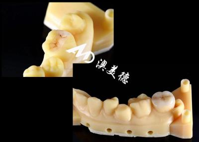 China Natural Color Precision Ceramic Inlays Onlays Teeth Hypoallergenic Seamless Fit for sale