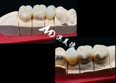 China OEM Precision Fit Ceramic Inlays And Onlays For Strong Natural Dental Restoration for sale