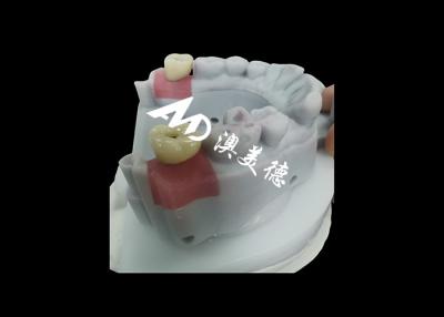 China Dental Implant Crown with titanium abutment for Durable Tooth Restoration for sale