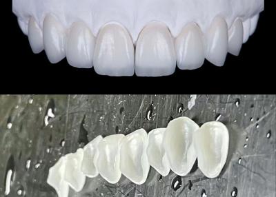 China IPS emax Press Porcelain Veneers Achieve a Natural and Radiant Smile for sale