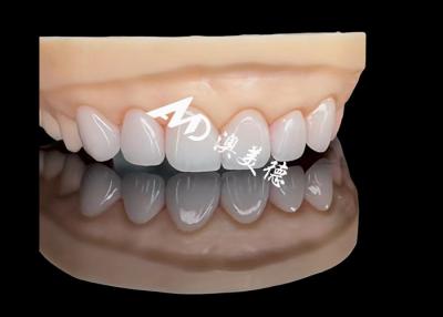 China Porcelain EMAX Veneer High Precision Esthetic Restorations with Superior Durability for sale