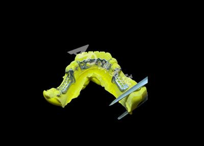 China Tailored Cast Partial Denture with Personalized Aesthetics and Secure Fit for Enhanced Comfort and Functionality for sale