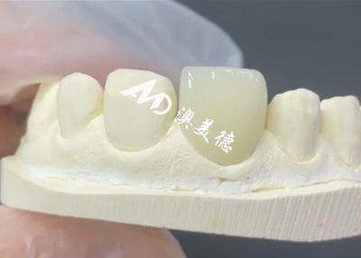 China Durable and Aesthetic EMAX Veneer The Perfect Solution for Porcelain Restorations for sale