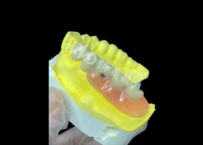 China Personalized PFM+Removable Dentures combo The Ultimate Solution for Comfort and Aesthetics for sale