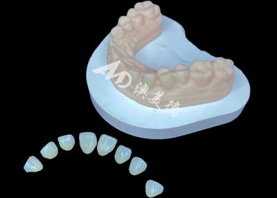 Cina IPS e.max Veneer Soluzione estetica premium per trasformazioni di sorriso mozzafiato in vendita