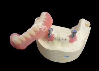 China Locator Overdenture Removable Implant Denture Solution For Enhanced Chewing And Speech for sale