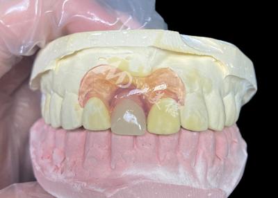 China Nesbit partial denture for incisors offering a seamless removable tooth replacement solution for sale