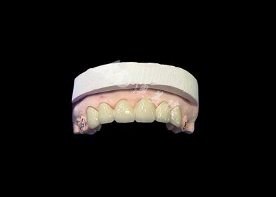 China Biocompatible Porcelain Fused To Metal Crown High Durability For Enhanced Restoration for sale