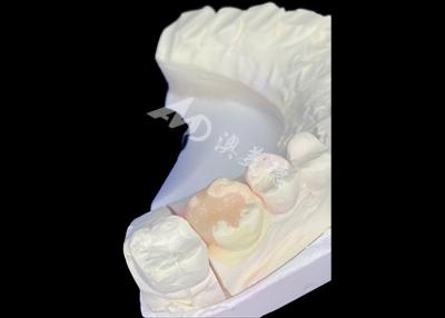 China Long-lasting Durability and Accurate Fit And Placement with IPS e.max inlays onlays for molar for sale