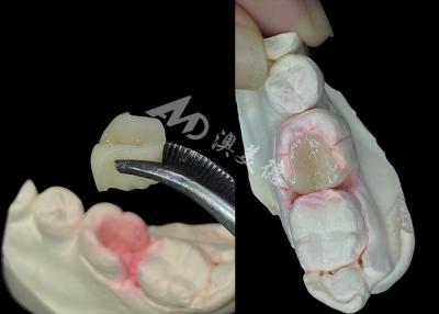 China IPS e.max Intracciones y onlays cerámicas para la restauración dental de aspecto natural en venta