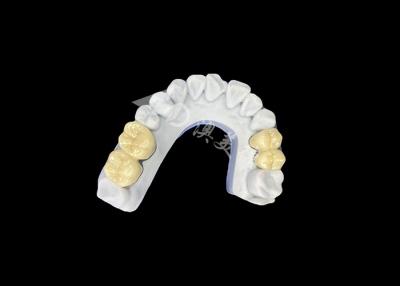 China Zirconia PFZ Porcelain Dental Crown From Professional China Dental Lab for sale