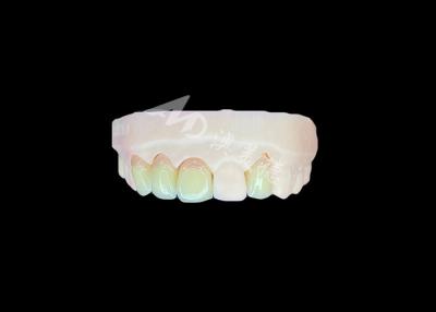 China Natural and Comfortable Fit Zirconia Porcelain Crown China Dental Lab Customizable Shade for sale