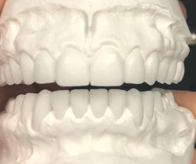 China Tooth Temporary Dental Implant Crown PMMA Biocompatible Ni Be Free for sale