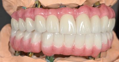 China Dental All On 4 Implant Supported Dentures Professional Natural Looking for sale