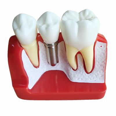 China Dentist Dental Regional Model 4 Periods Dental Implant Bridge Crown Analysis Patience Model Removable Dental Demonstration Teeth for sale