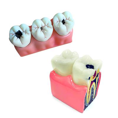 China Easy Dental Caries Demonstration Dental Model Dental Operation Dental Equipment Dental Model for sale