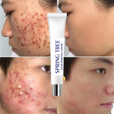 China Herbal Acne Scar Removal Cream Private Label Acne Treatment Acne Remover Organic Soft Quick Acne Anti Acne Scar Removal Cream for sale