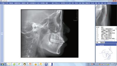 중국 CBCT 콘 광속 컴퓨터 단층 촬영 장비를 위한 연합되는 Cephalometric 측정 소프트웨어 판매용