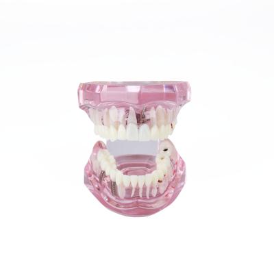 China Anatomy vivid implant dental model with pathologies, bridge and restoration for sale