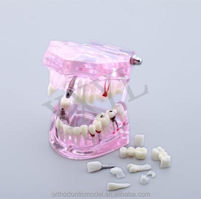 China plastic tooth model for student training M 2001 for sale