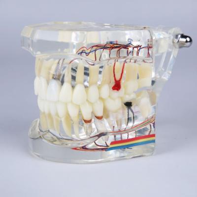 China New medical school design implant and restoration dental model with nerve to demonstrate endo formation for sale