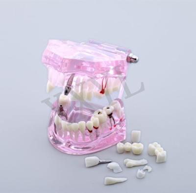 China Clinics implant the restoration pathological dental model for demonstration for sale