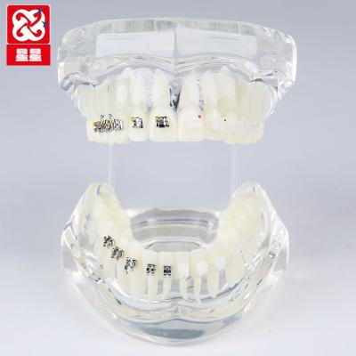 China Human simulation demo realistic transparent orthodontic model with ceramic and metal brackets for sale